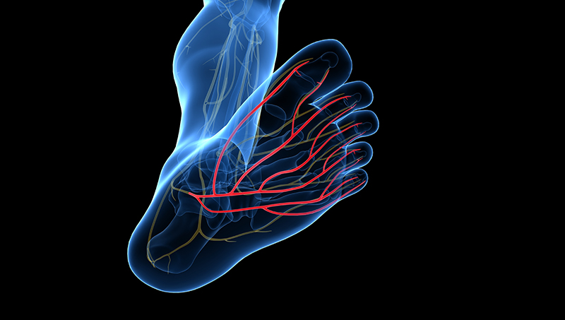 Nerve damage in foot causing neuropathy