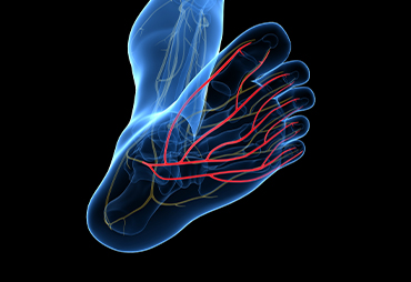 Nerve damage in foot causing neuropathy