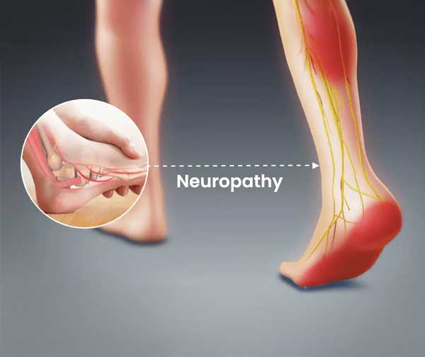 neuropathy appointment scheduling over the phone